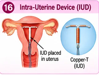 A Copper-T intra-uterine device placed in the uterus, with a close-up of the device