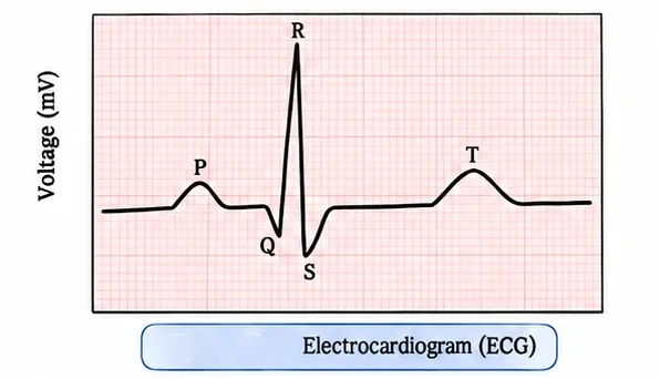 Standard electrocardiogram trace showing the P wave, the QRS complex and the T wave