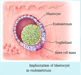 A blastocyst embedding in the endometrium, showing the trophoblast in contact with the uterine lining and the inner cell mass