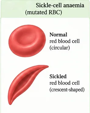 A normal round biconcave red blood cell beside a sickle-shaped crescent red blood cell