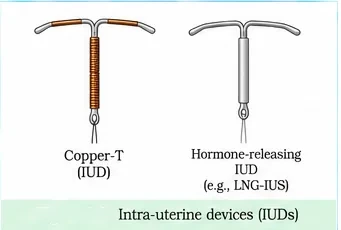 A Copper-T intrauterine device wound with copper wire, and a hormone-releasing intrauterine device such as LNG-IUS