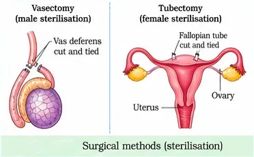 Vasectomy with the vas deferens cut and tied, and tubectomy with the fallopian tubes cut and tied