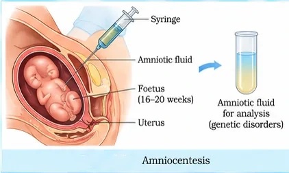A syringe needle inserted through the abdominal wall into the amniotic fluid around a foetus of 16–20 weeks, with withdrawn fluid in a test tube for genetic analysis