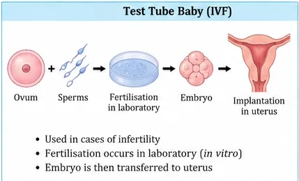 Steps of test-tube baby technique: ovum and sperms are fertilised in a laboratory dish, the resulting embryo is then implanted in the uterus
